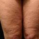 Cellulite Bühne Foto
