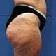 das Stadium der Cellulite